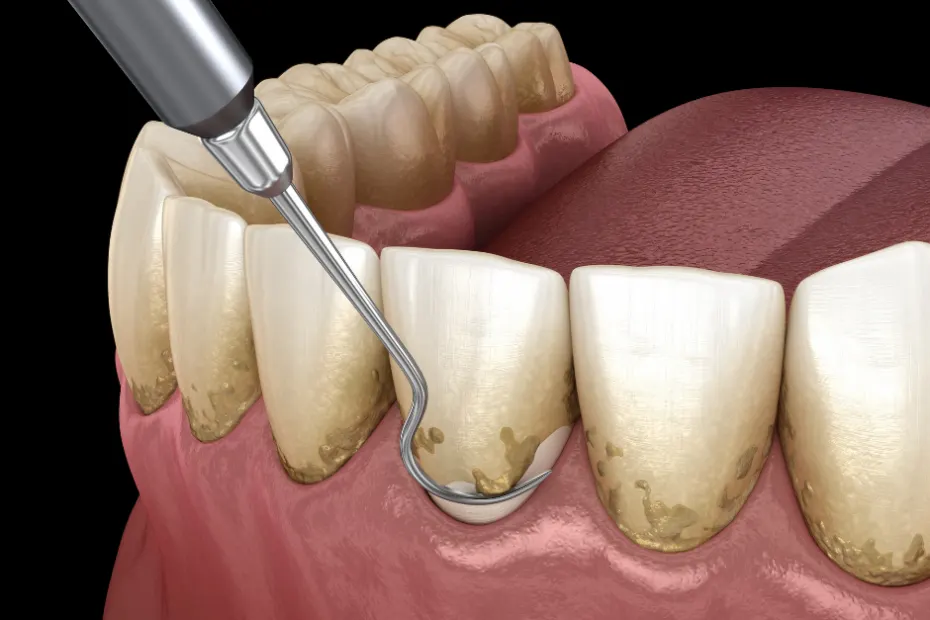 Gum care at Mercado Dental Studio