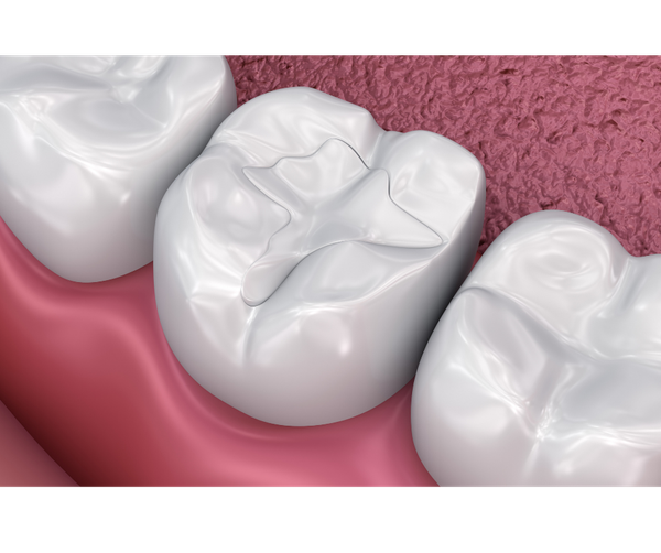 BioClear dental restoration results