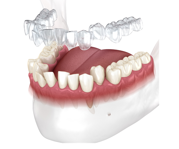 Clear Invisalign aligners