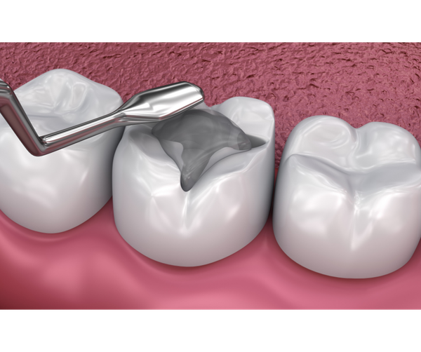 Root canal endodontic therapy