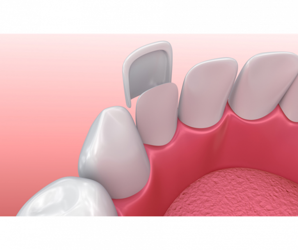 Porcelain dental veneers before and after
