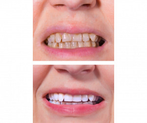 Professional teeth whitening results