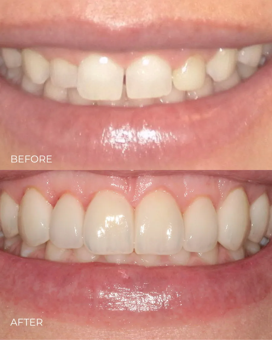 Before-and-after smile transformation by Dr. Alex Mercado