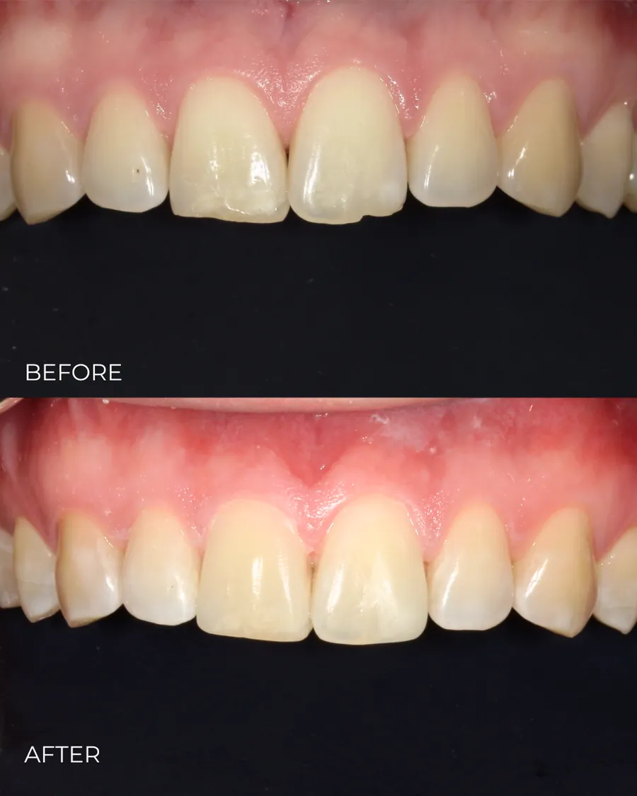 Before-and-after smile transformation by Dr. Alex Mercado