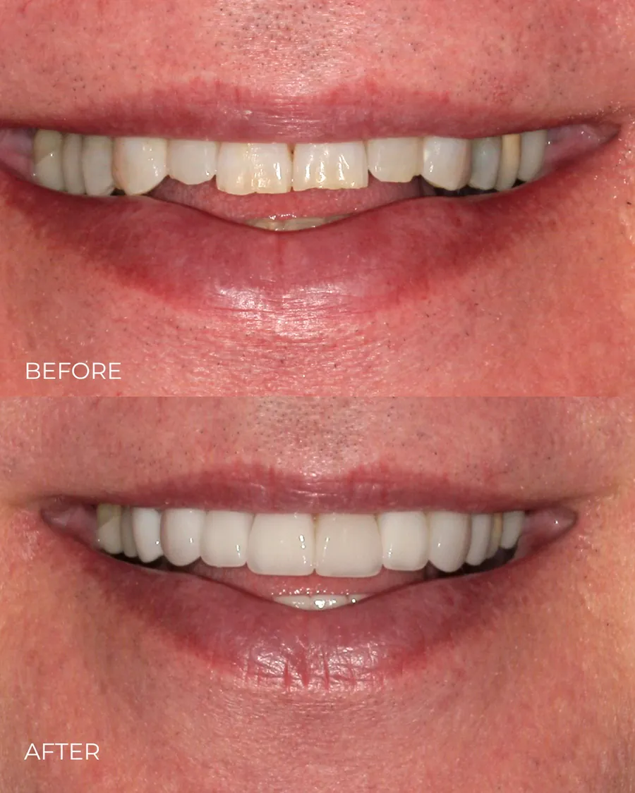 Before-and-after smile transformation by Dr. Alex Mercado