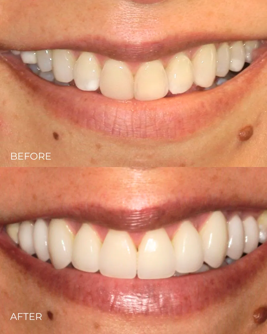 Before-and-after smile transformation by Dr. Alex Mercado
