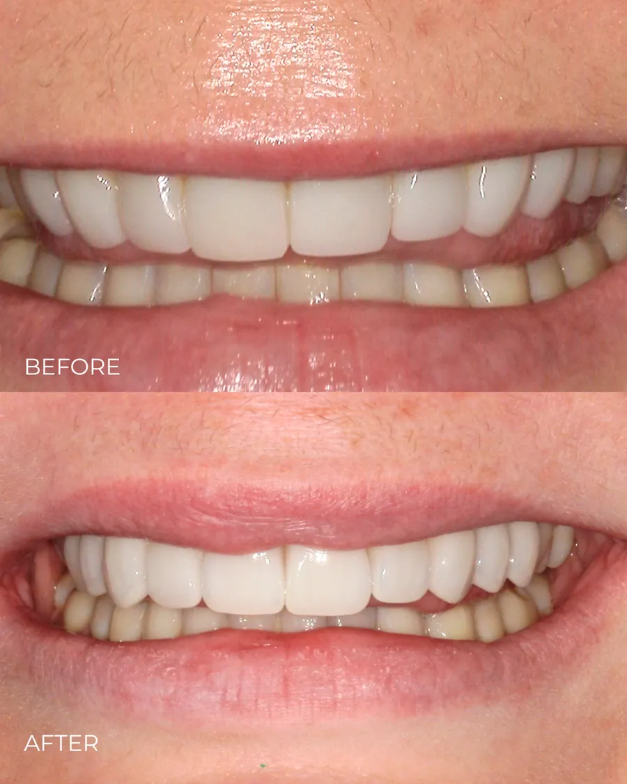 Before-and-after smile transformation by Dr. Alex Mercado