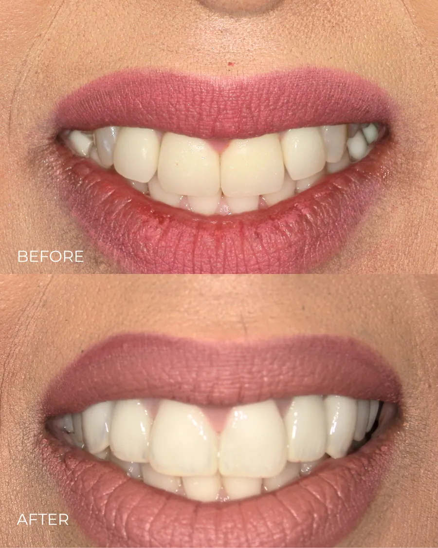 Before-and-after smile transformation by Dr. Alex Mercado