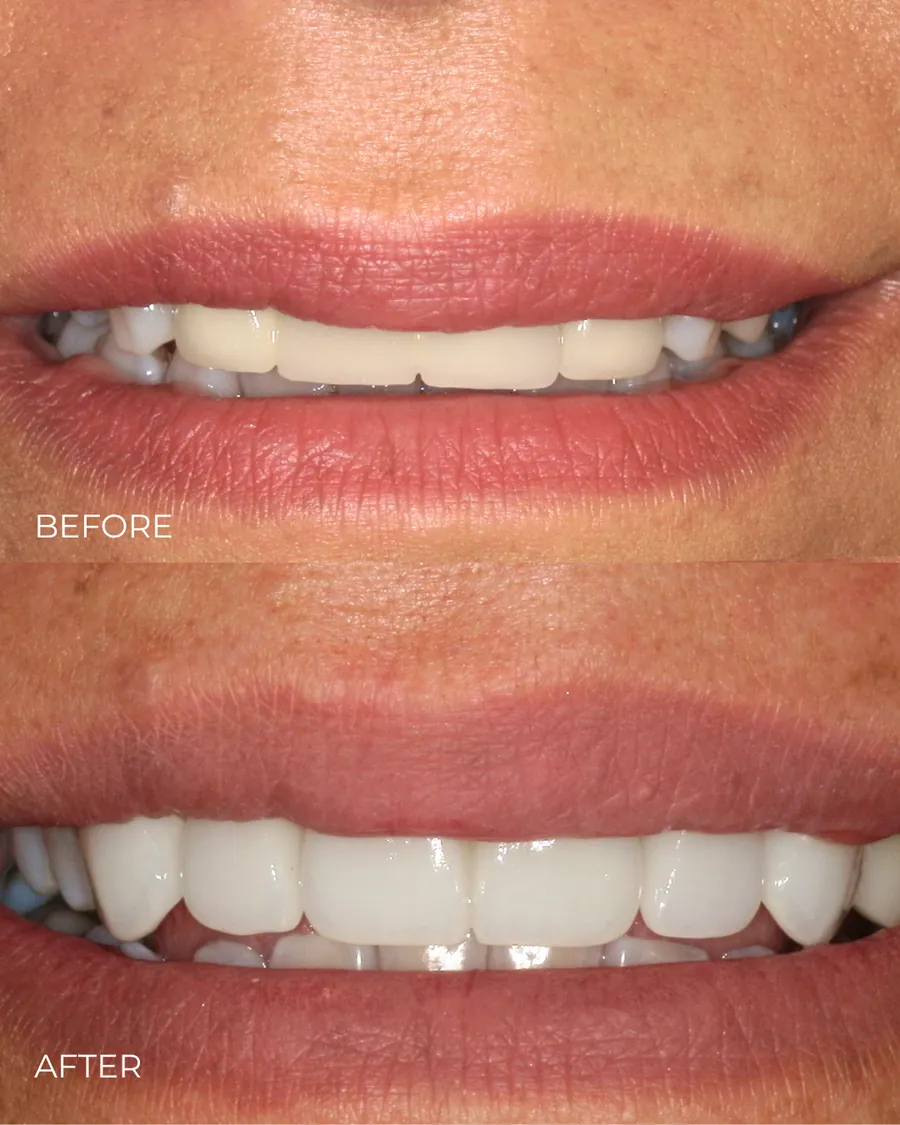 Before-and-after smile transformation by Dr. Alex Mercado