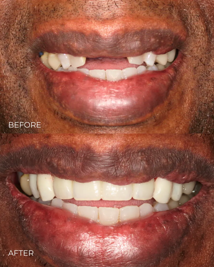 Before-and-after smile transformation by Dr. Alex Mercado