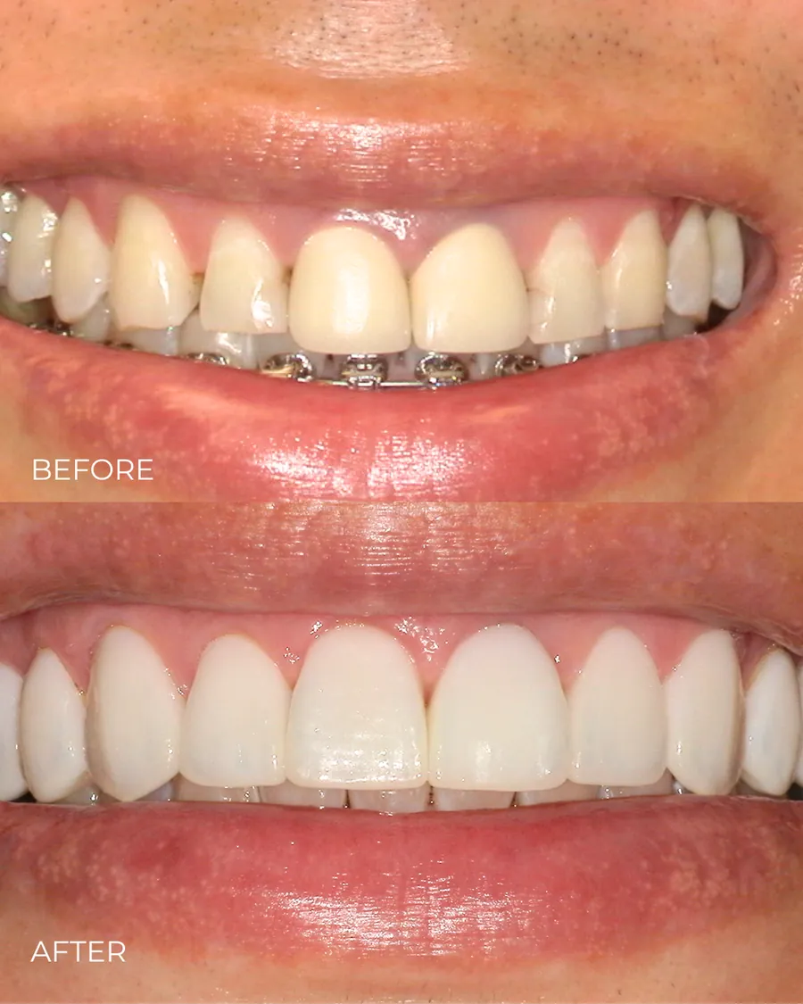 Before-and-after smile transformation by Dr. Alex Mercado