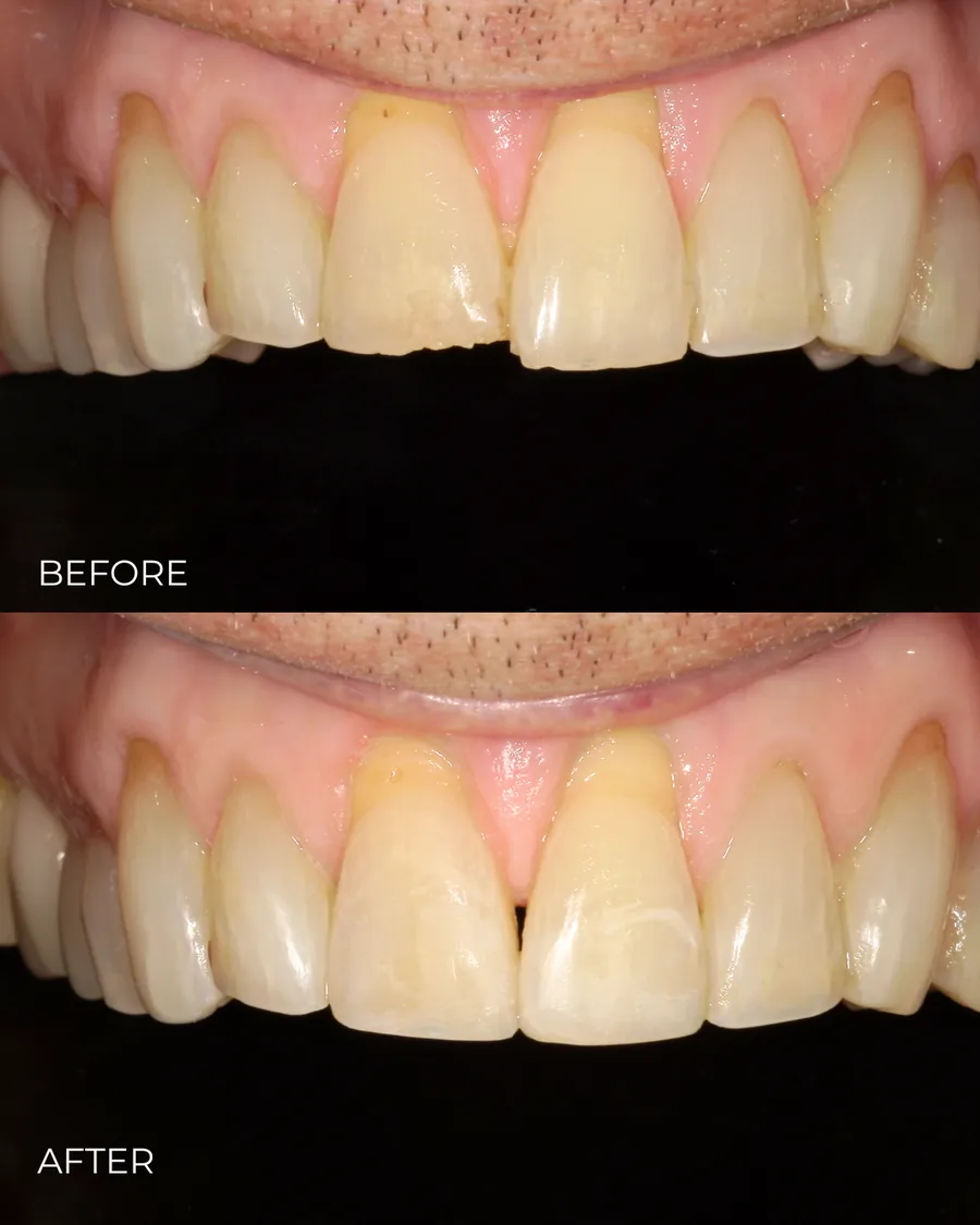 Before-and-after smile transformation by Dr. Alex Mercado