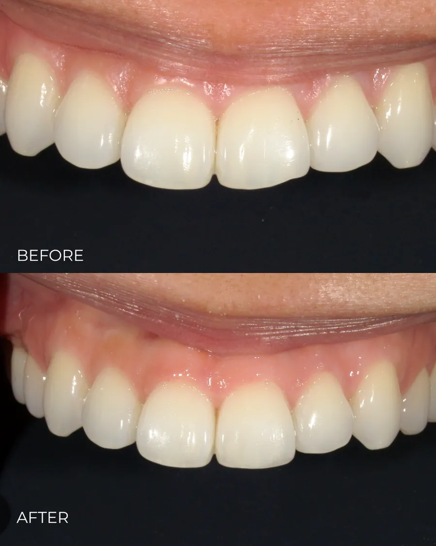 Before-and-after smile transformation by Dr. Alex Mercado