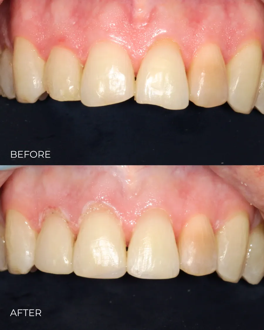 Before-and-after smile transformation by Dr. Alex Mercado