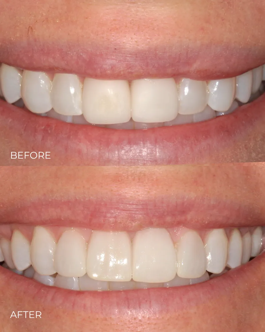 Before-and-after smile transformation by Dr. Alex Mercado