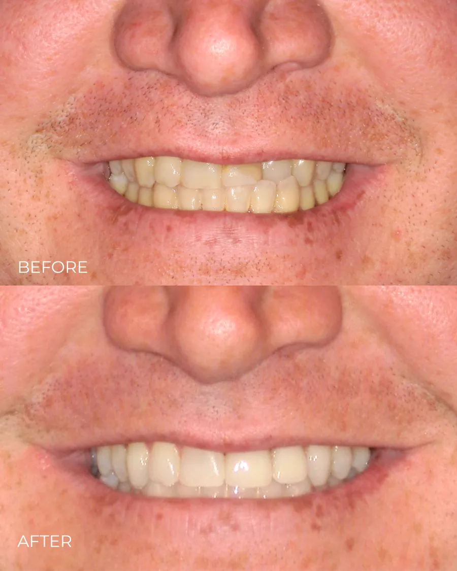 Before-and-after smile transformation by Dr. Alex Mercado