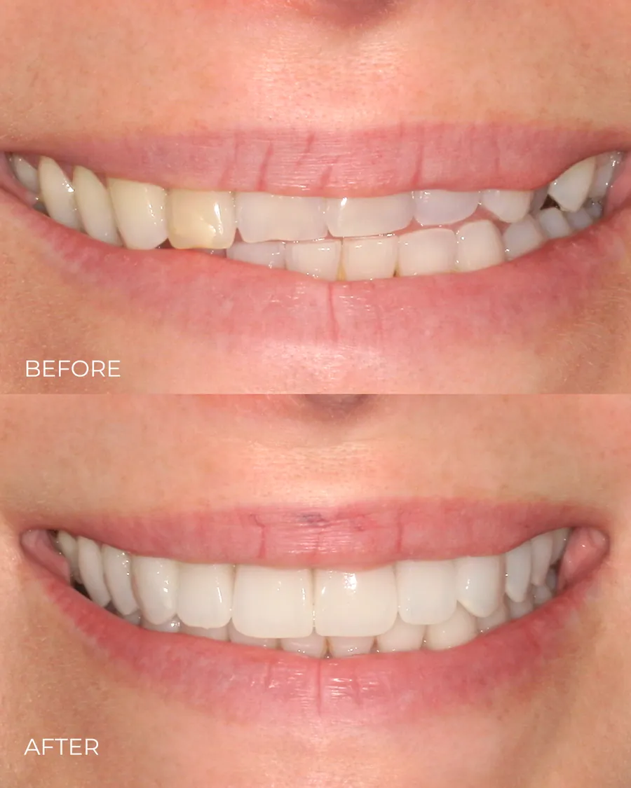 Before-and-after smile transformation by Dr. Alex Mercado
