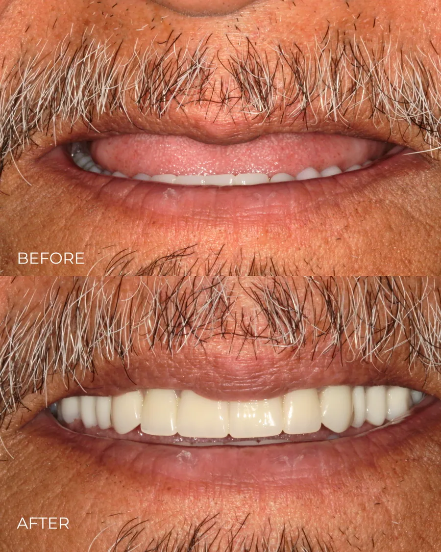 Before-and-after smile transformation by Dr. Alex Mercado