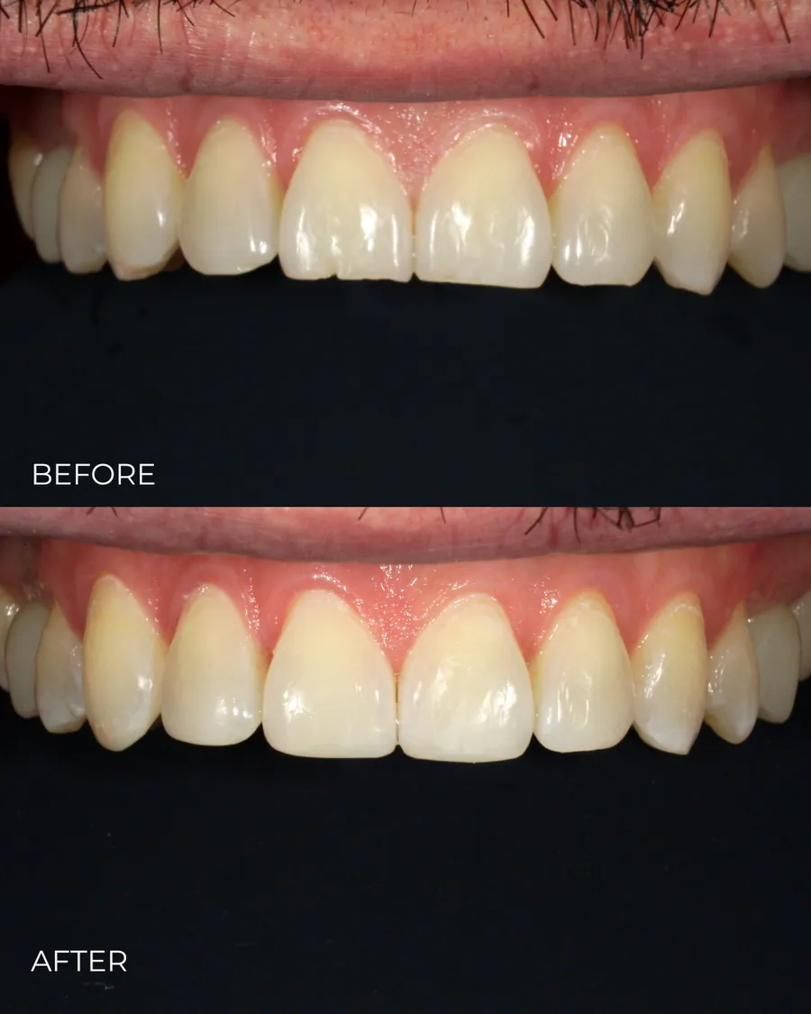 Before-and-after smile transformation by Dr. Alex Mercado
