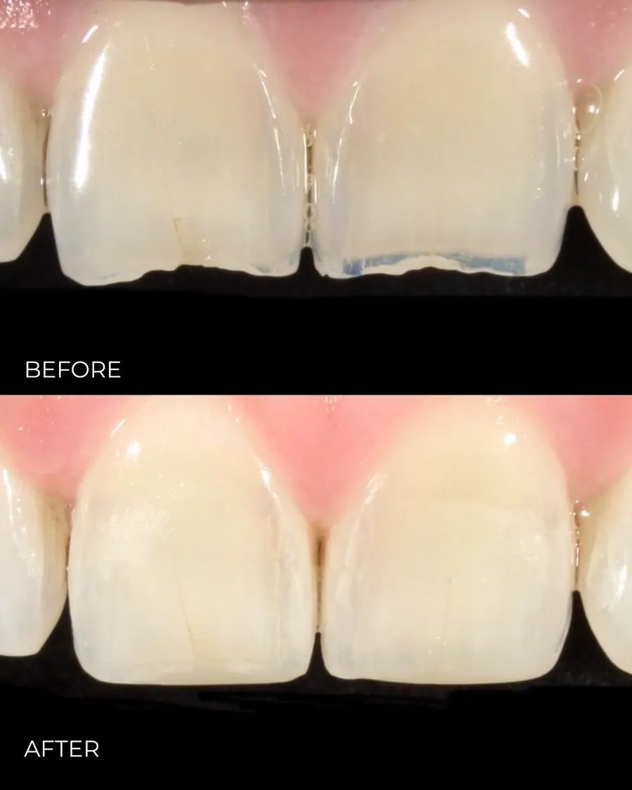 Before-and-after smile transformation by Dr. Alex Mercado