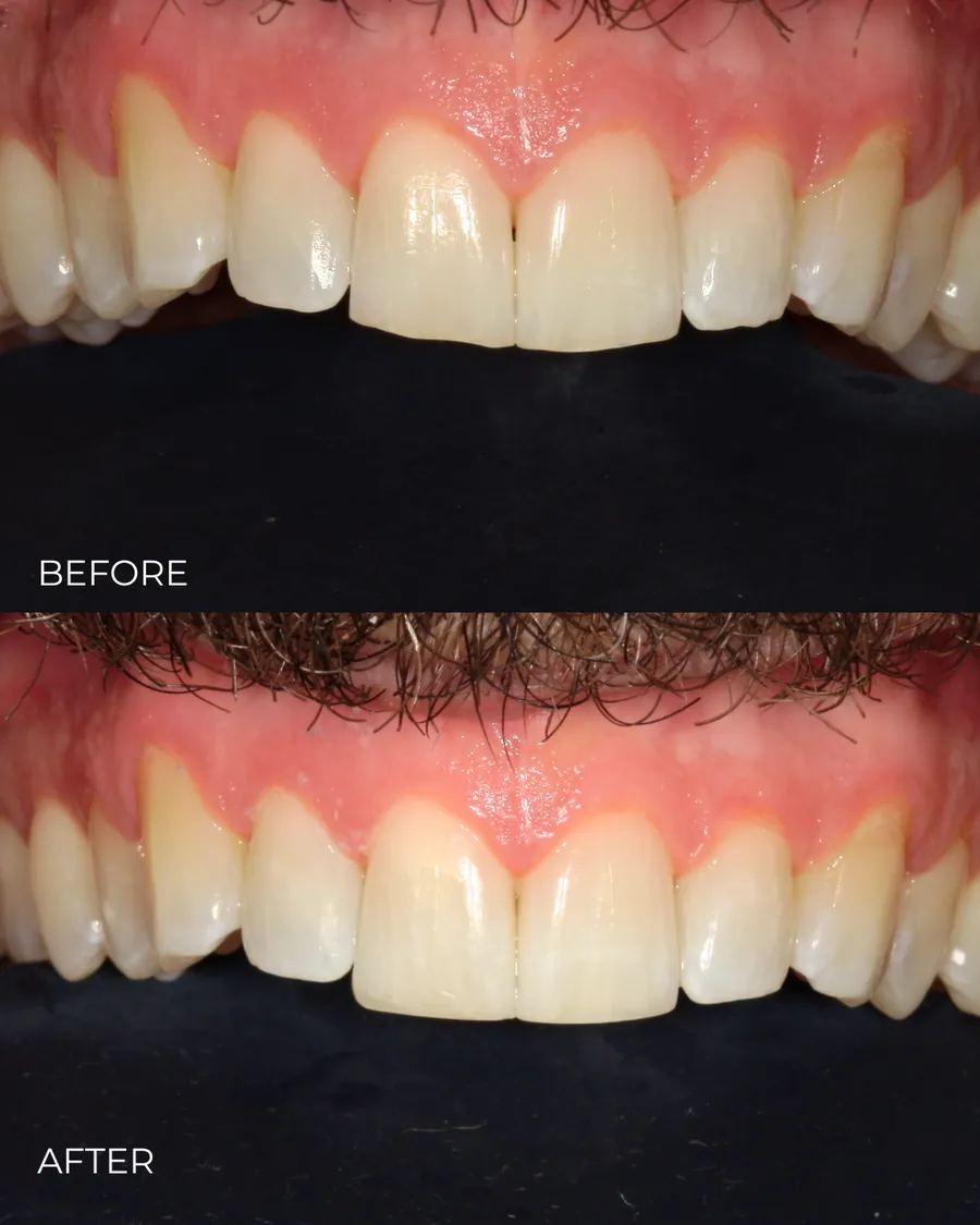 Before-and-after smile transformation by Dr. Alex Mercado