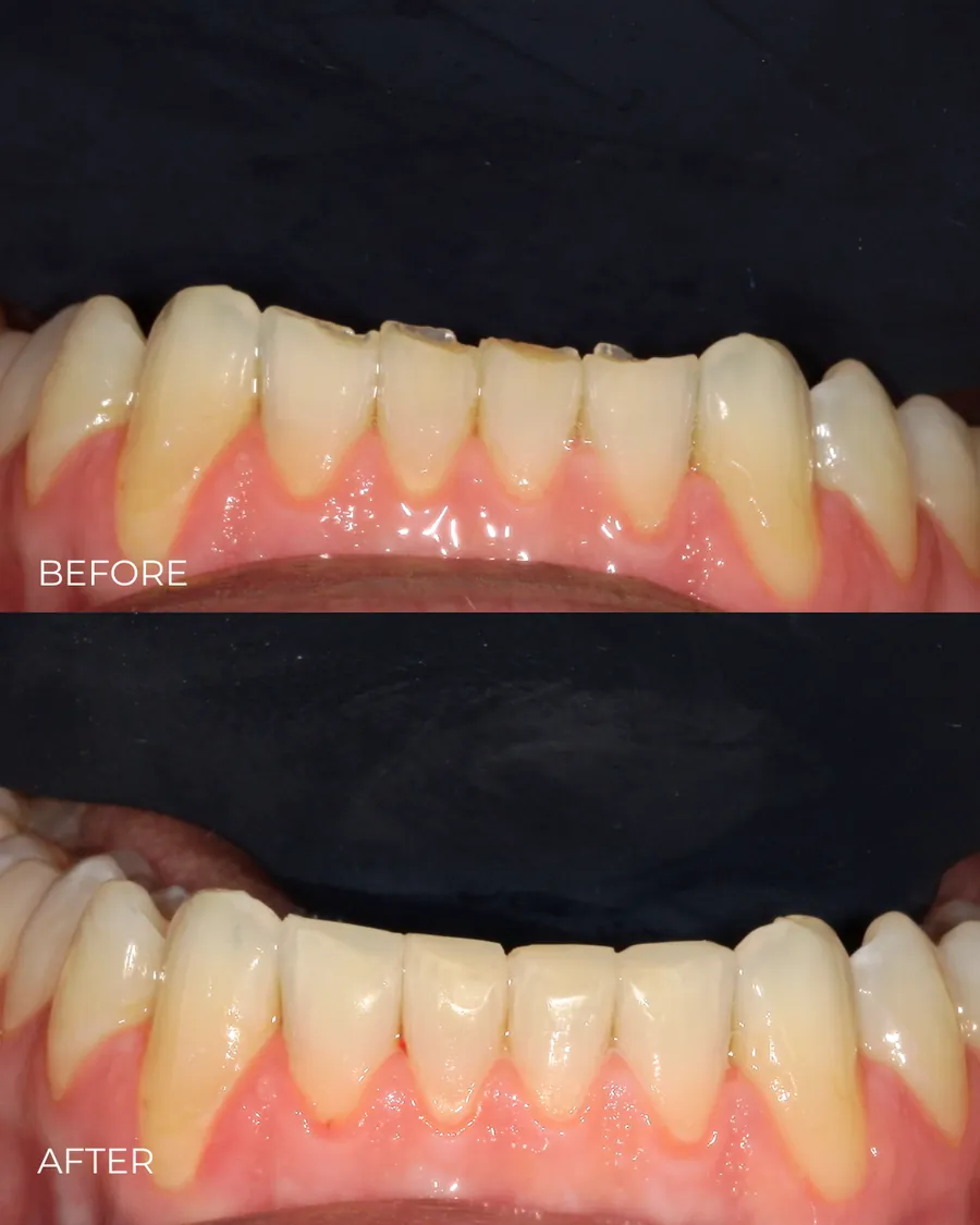 Before-and-after smile transformation by Dr. Alex Mercado