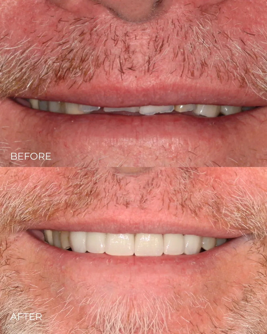 Before-and-after smile transformation by Dr. Alex Mercado