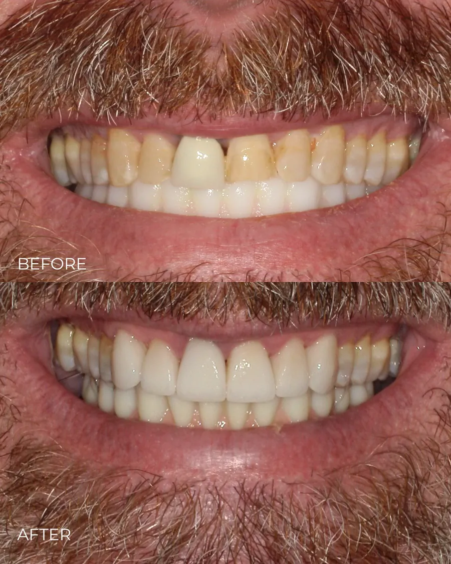 Before-and-after smile transformation by Dr. Alex Mercado