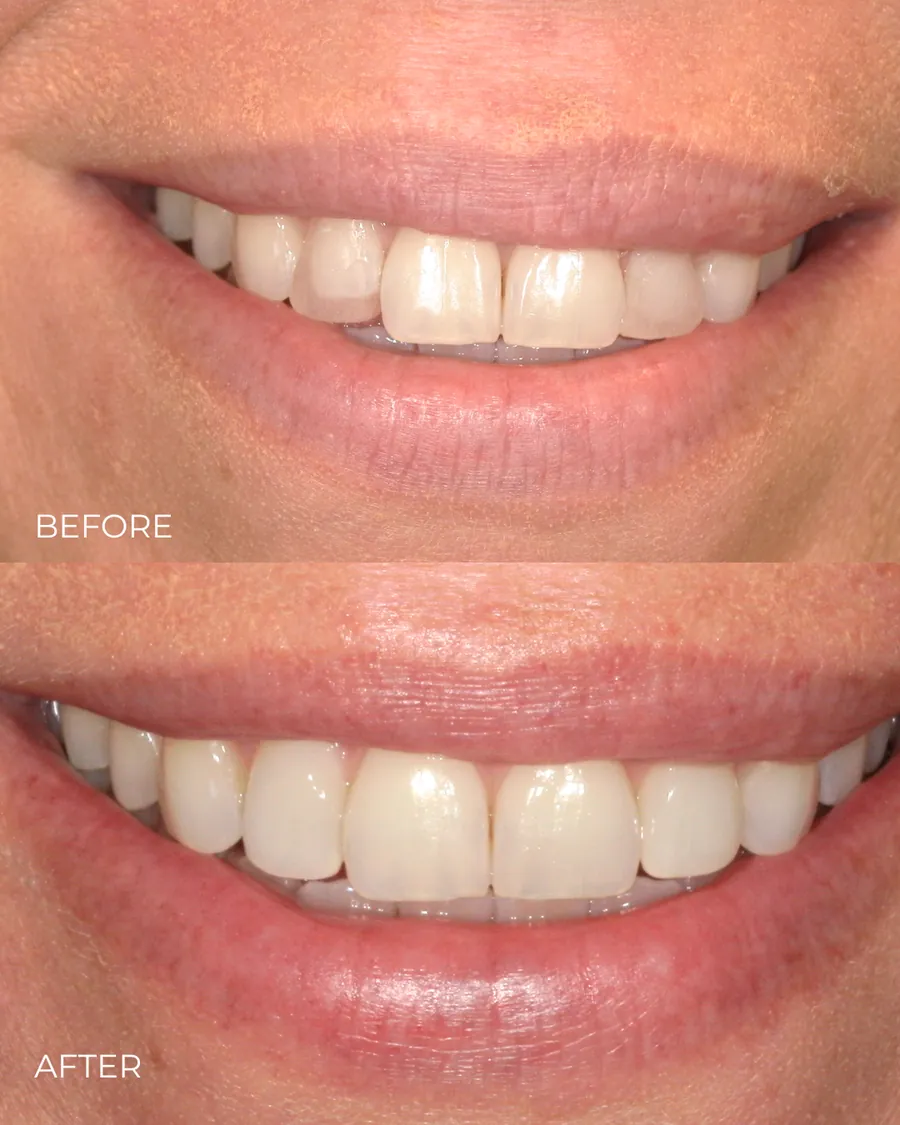 Before-and-after smile transformation by Dr. Alex Mercado