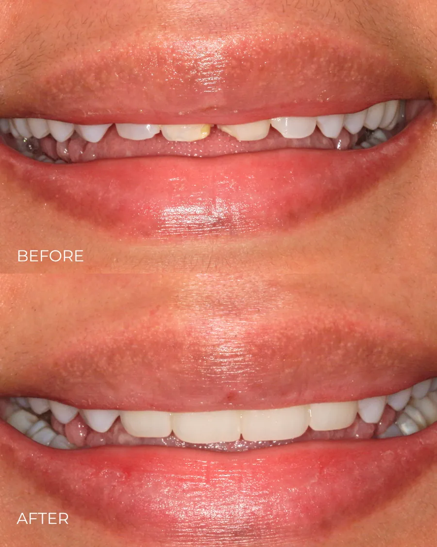 Before-and-after smile transformation by Dr. Alex Mercado