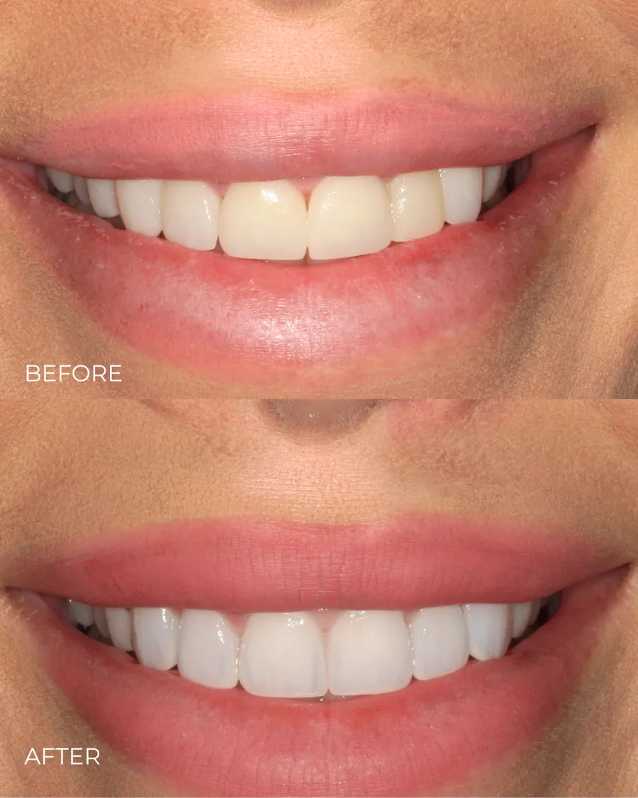 Before-and-after smile transformation by Dr. Alex Mercado