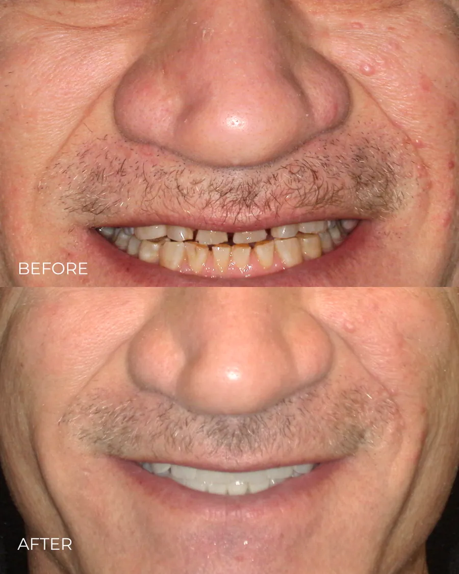 Before-and-after smile transformation by Dr. Alex Mercado