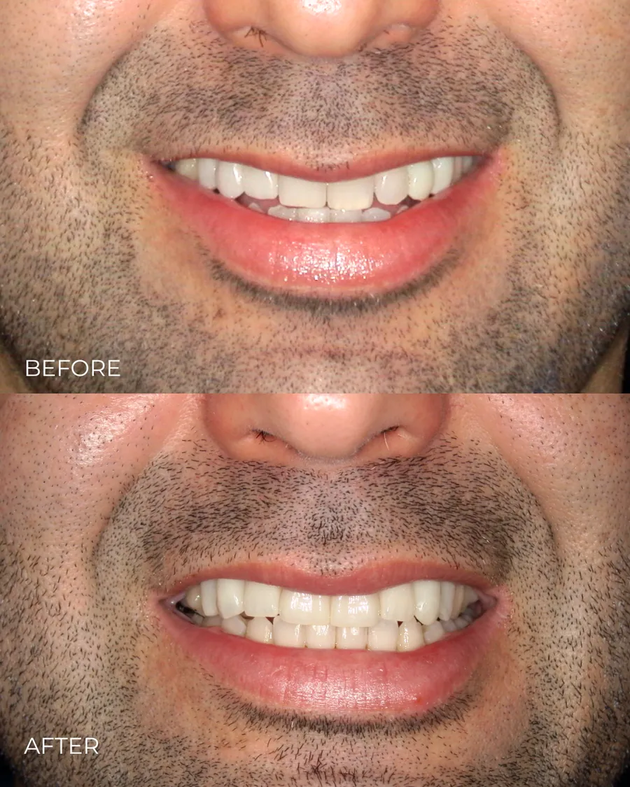 Before-and-after smile transformation by Dr. Alex Mercado