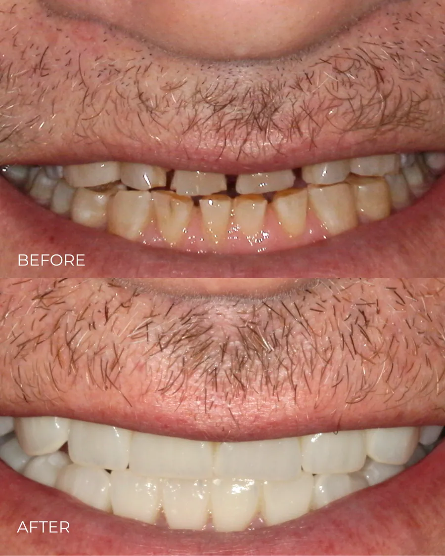Before-and-after smile transformation by Dr. Alex Mercado