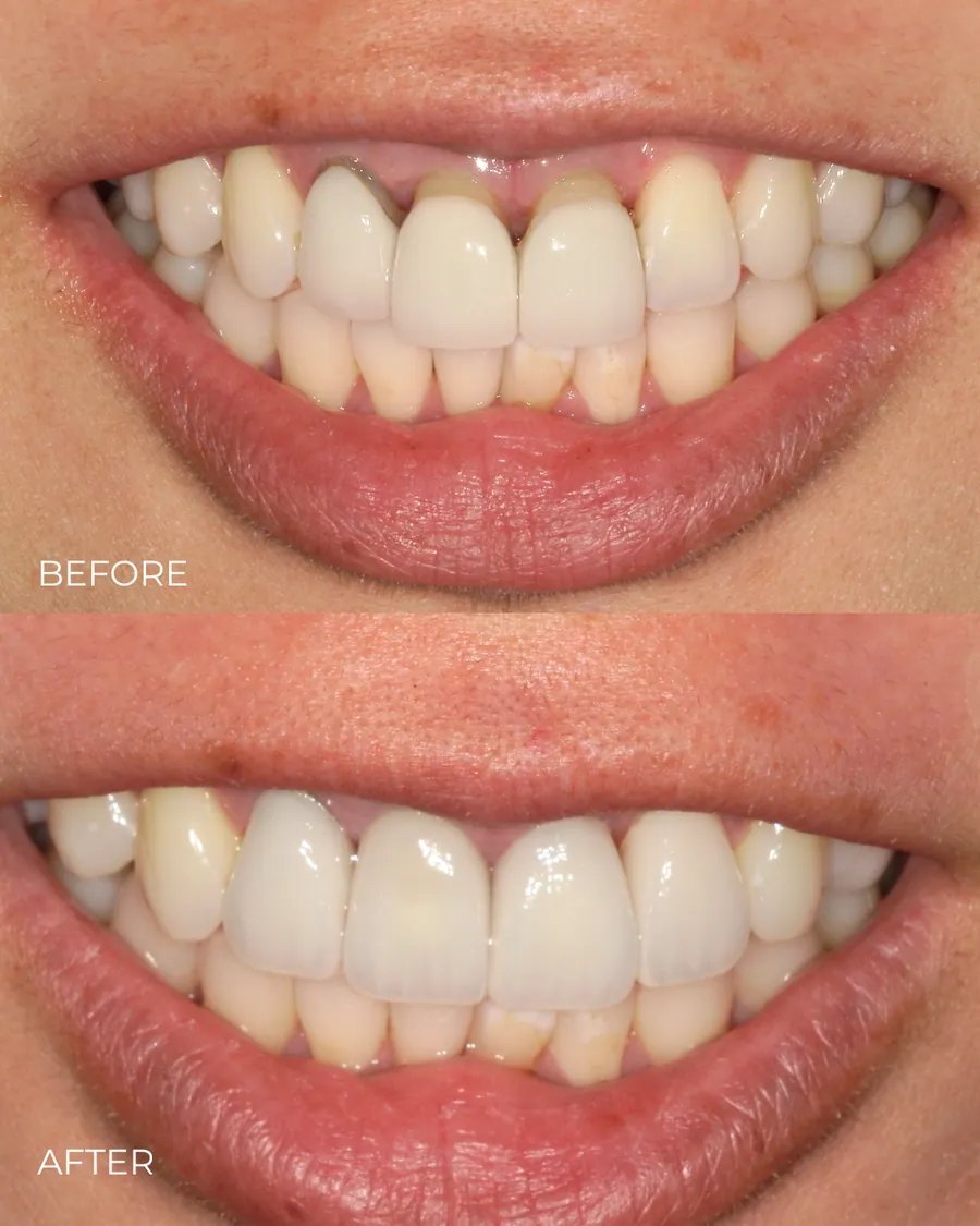 Before-and-after smile transformation by Dr. Alex Mercado