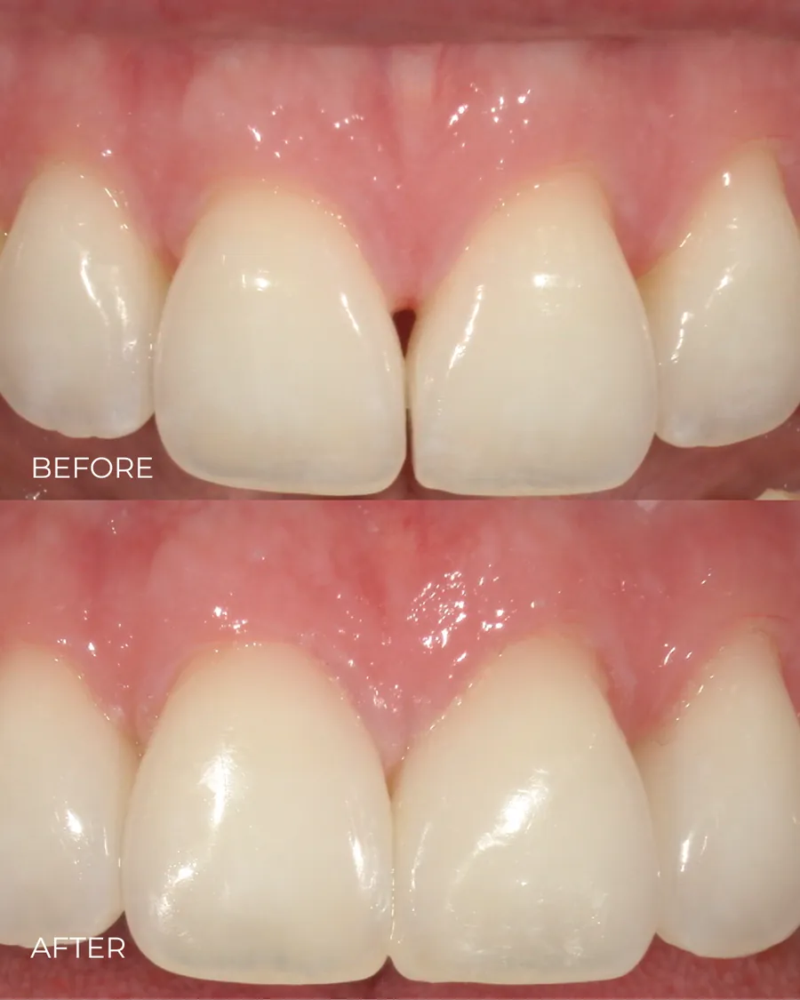 Before-and-after smile transformation by Dr. Alex Mercado